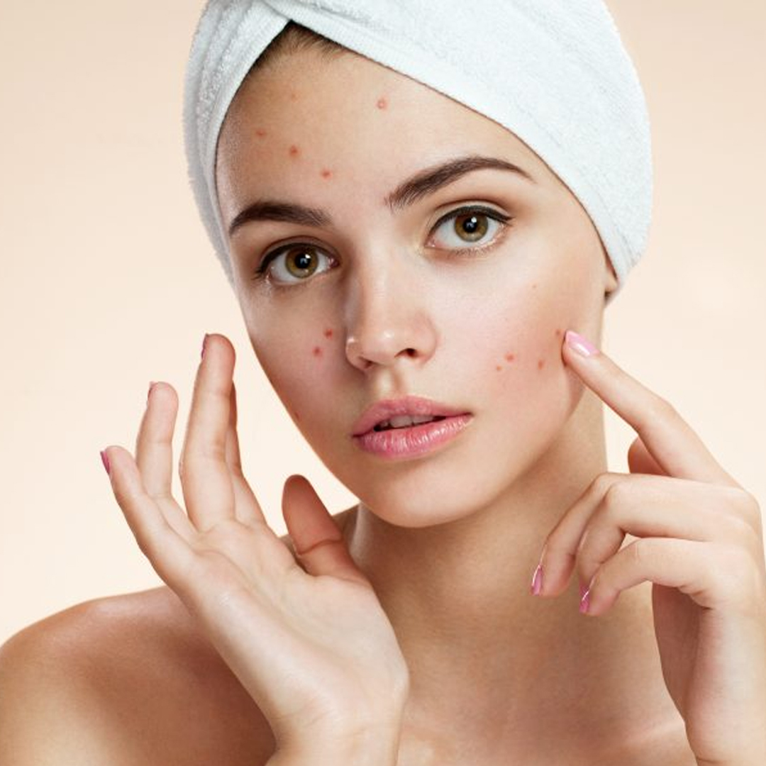 Face Acne available in online  pharmacy qatar, doha 
